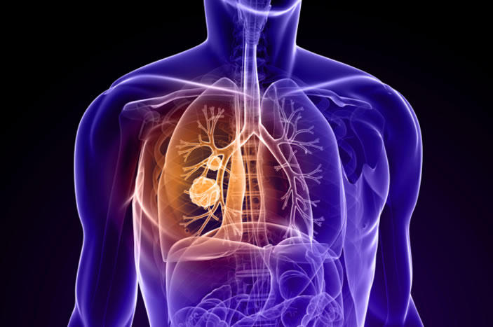 A graphic of lungs affected by cancer