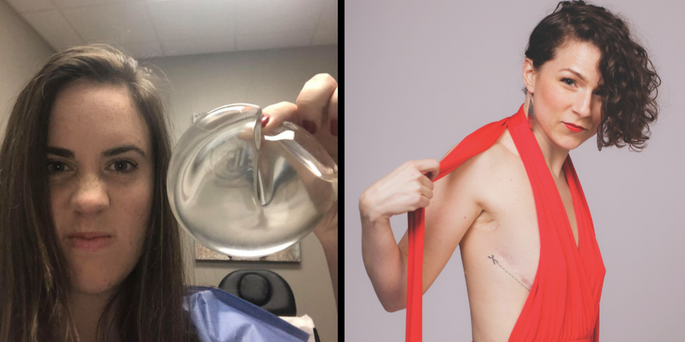 Breast Implant Removal in Atlanta