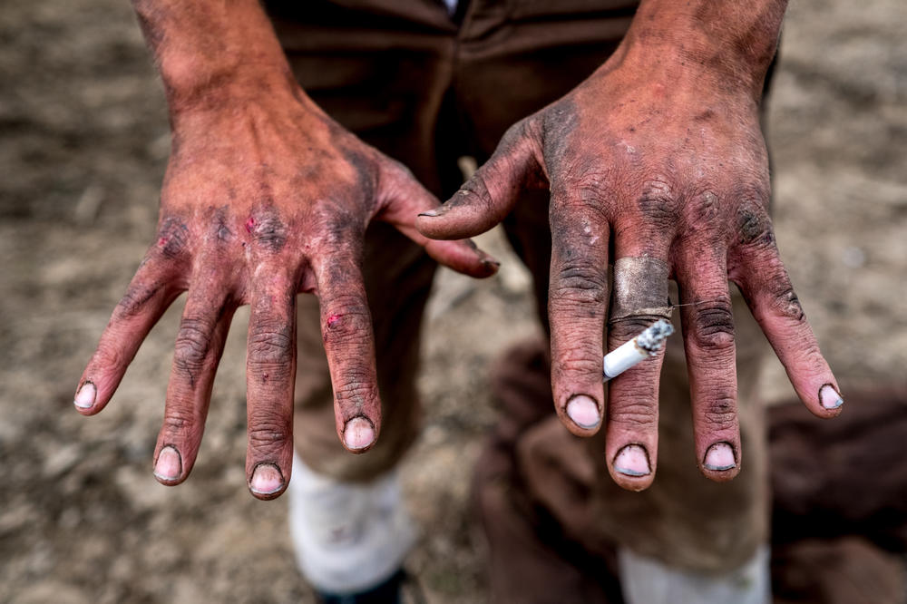 A planter's hands at the end of a work day. Cuts and infections are a normal part of the job and maintaining personal hygiene in a bush environment is a constant challenge.
