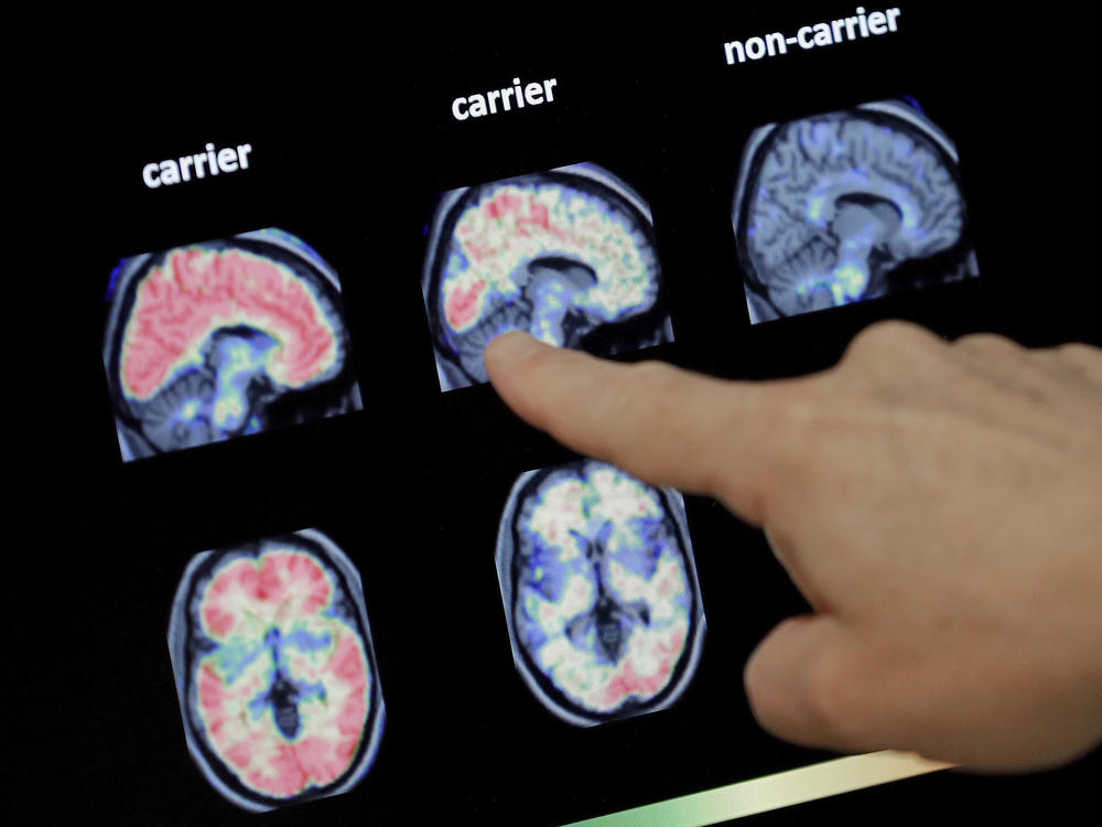 Scientists say research into Alzheimer's needs to take a broader view of how the disease affects the brain — whether that's changes in the cortex or the role of inflammation.