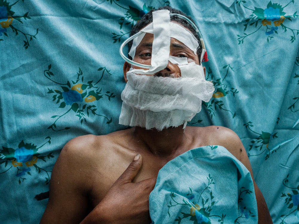 An injured Tigray People's Liberation Front fighter who was shot in the cheek recovers after surgery at the Ayder Comprehensive Specialized Hospital in Mekele, the capital of Ethiopia's Tigray region. It's the only place in Tigray currently conducting surgery. Elsewhere, 