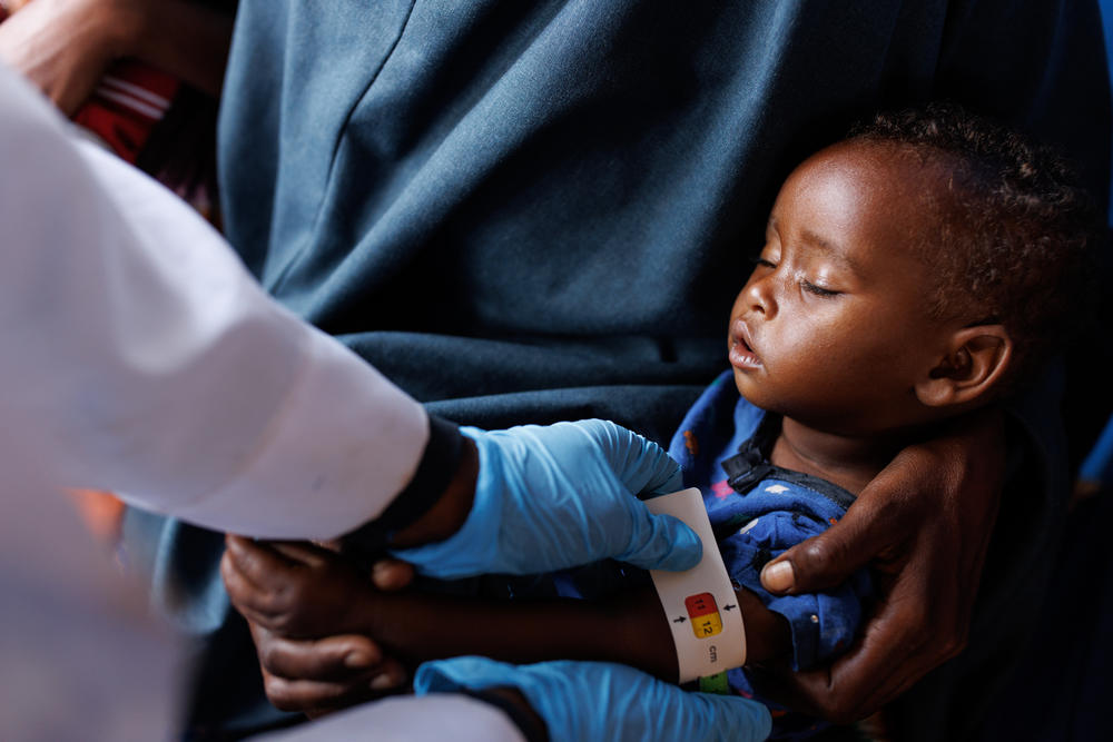 A child's upper-arm circumference is measured at a clinic in a camp for displaced people in Baidoa, Somalia. A measurement in the red indicates that the child has 