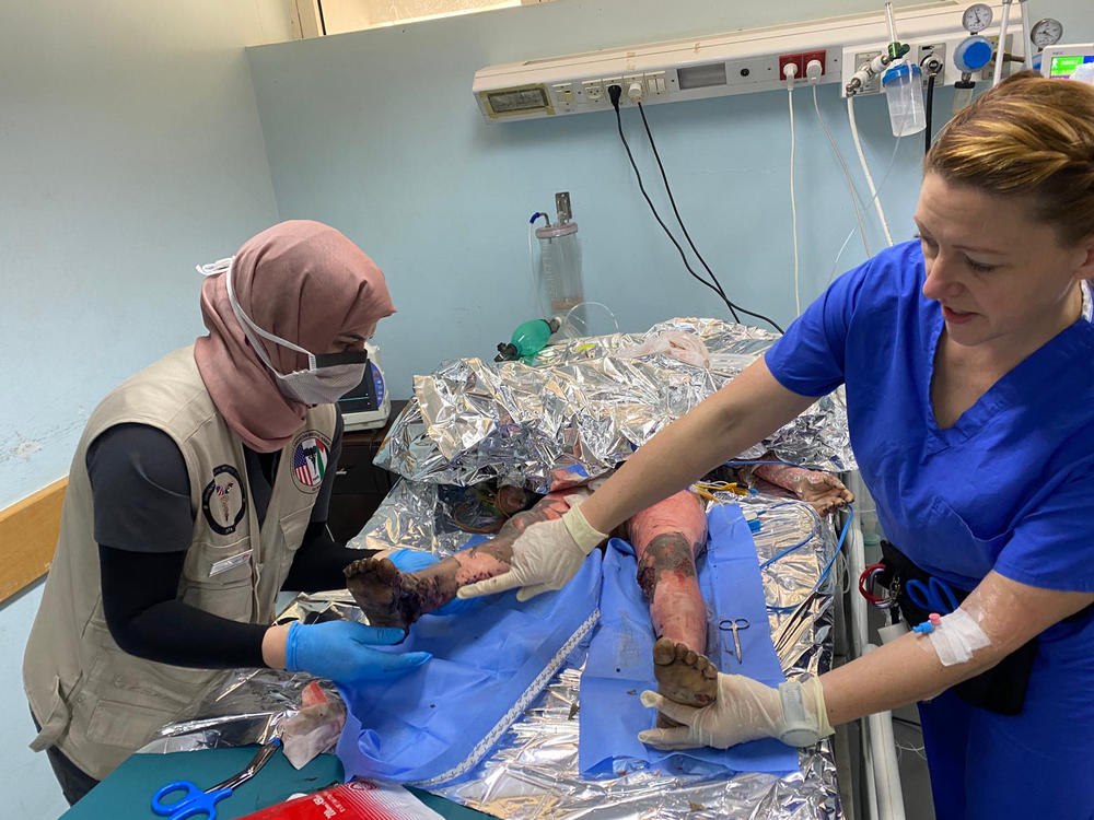 Burn nurse Monica Johnston on Thursday shows a local nurse a burn wound on 7-year-old Zain Abu Obeid, who was injured in a blast that killed his family. He died four days later.