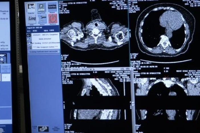 MD says many  fatal lung cancer cases could be saved with early low-dose CT screening.