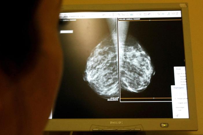 New guidelines recommend earlier mammograms amid rise in breast cancer among younger women