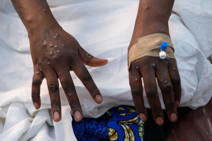 Why it's so difficult to get mpox vaccines to areas facing an outbreak