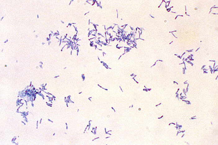 The potentially fatal disease diphtheria is caused by bacteria — the club-shaped, Gram-positive, Corynebacterium diphtheriae bacilli shown in this microscope photo.